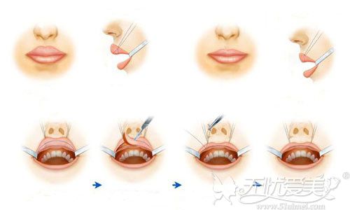 厚唇改薄手术过程