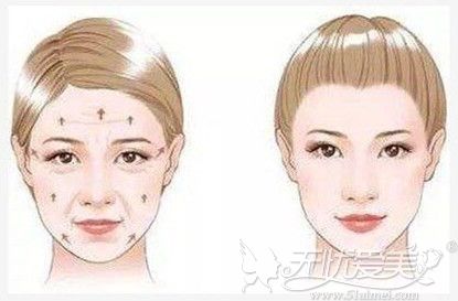 面部埋线提升可以改善松弛下垂