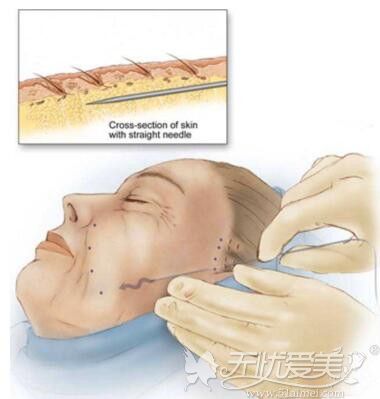 面部埋线提升手术过程