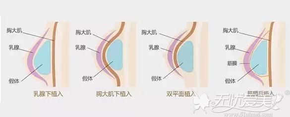 假体隆胸植入的四个层次