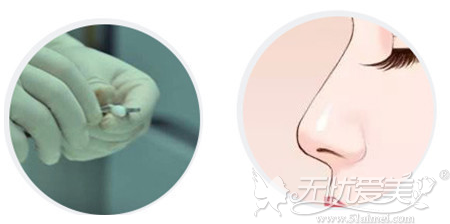 呼和浩特专业肋骨鼻修复设计美学