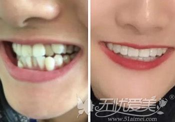 牙齿矫正2年后的效果对比