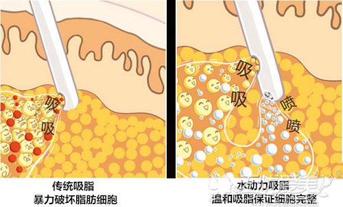 水动力吸脂和传统吸脂的区别