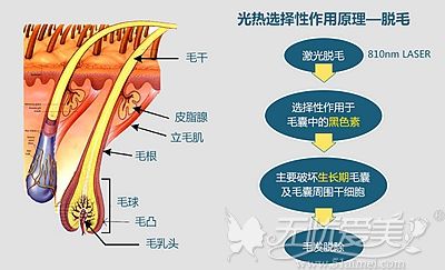 冰点脱毛的优势和费用