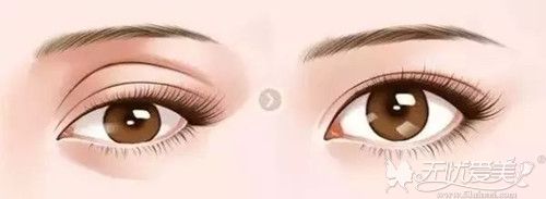 三层双眼皮要怎么变回双眼皮得先考虑折痕原因再对症消除