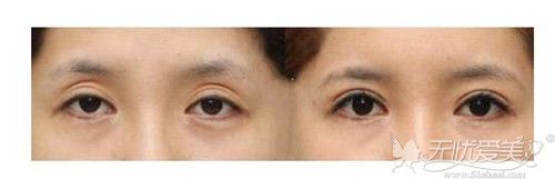 三层眼皮修复案例