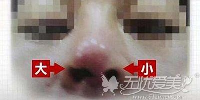 隆鼻后鼻孔一大一小的原因