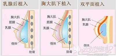 假体隆胸的植入层次