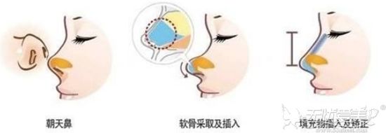 北京鼻综合手术可避免“猪鼻子”