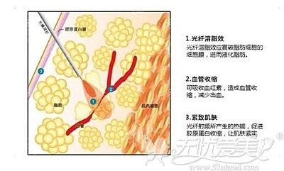 说是光纤溶脂三个月后会增生,那做负压面部吸脂手术会吗？