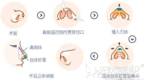 鼻综合修复手术的过程