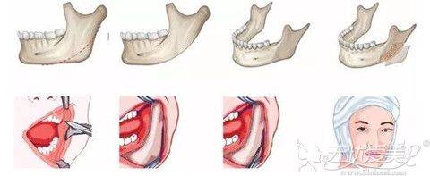 下颌角整形手术过程