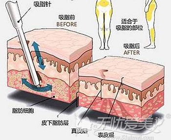 大腿吸脂是会留一定量的脂肪厚度的