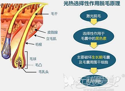 激光脱毛的原理和维持时间