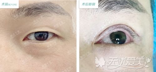 在广州做全切双眼皮手术即刻效果