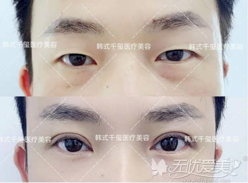 在广州做全切双眼皮手术后恢复