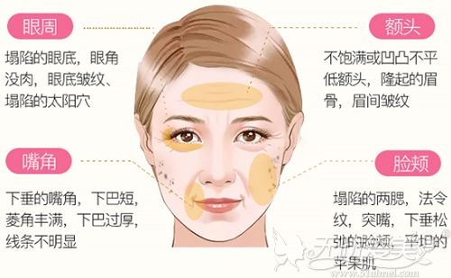 面部脂肪可以改善的面部缺陷