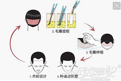 广州做5000个毛囊植发的价格很贵而且效果只能维持两年？