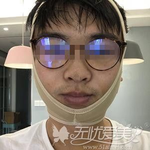 在郑州做下颌角手术后7天照片