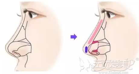 一万多的鼻综合靠谱么？谁有综合耳软骨隆鼻全过程照片？