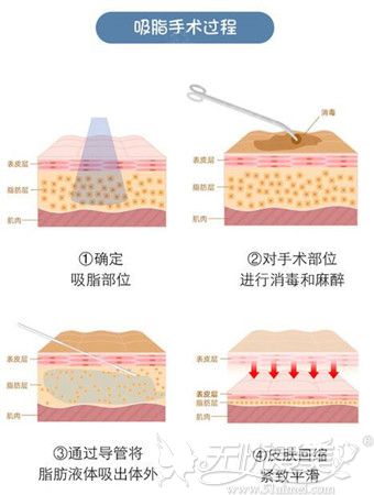 腰腹吸脂手术过程