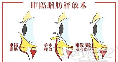 据说眶隔释放去眼袋后不是出现黑眼圈就是有凹陷的后遗症?