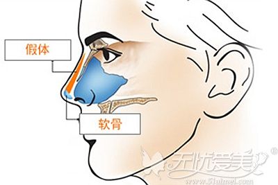 解析耳软骨隆鼻的原理
