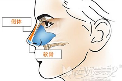 从鼻综合术后对比图中来瞧瞧耳软骨隆鼻半年就没了能信不