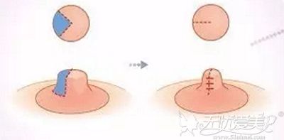乳头缩小手术的原理图