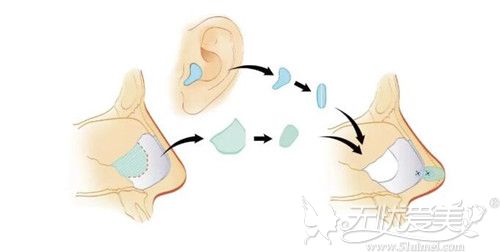 耳软骨隆鼻过程