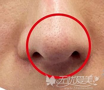 耳软骨垫鼻尖显形怎么修复?可以不动假体单独修复鼻尖吗?