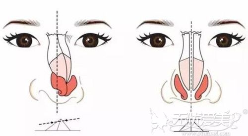 鼻综合鼻假体外斜多久可以矫正？看鼻子歪了较佳修复时间