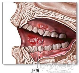 牙龈癌怎么预防