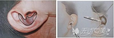 耳软骨隆鼻的切口位置