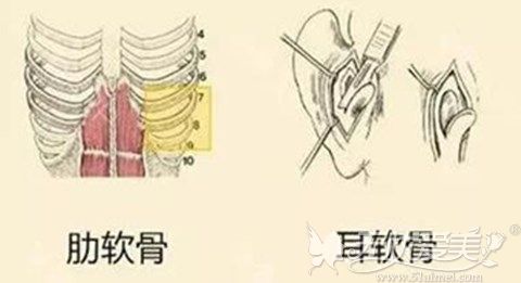 隆鼻前先了解耳软骨和肋骨的差别后才知道哪个更容易吸收