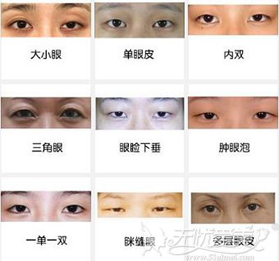 眼综合可以改善的眼睛类型