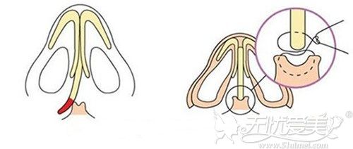 鼻中隔歪曲的矫正方法