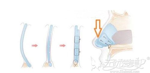 歪鼻矫正的手术方法