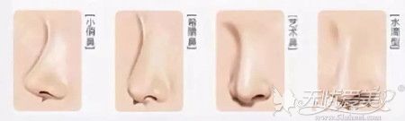 硅胶隆鼻后的不同鼻型