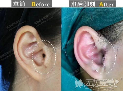 广州高尚二次耳屏畸形修复案例
