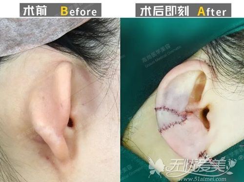 广州高尚耳扇畸形修复术案例