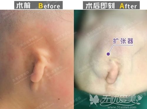 余文林肋骨耳再造一期手术