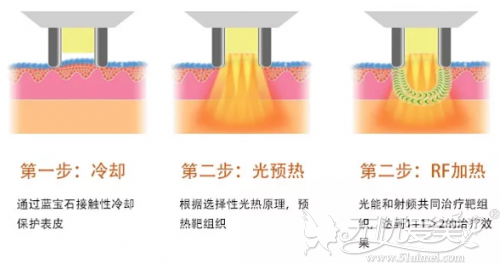 M22光子嫩肤治疗原理