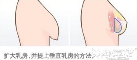 胸部松弛下垂要先提升乳房在进行假体填充