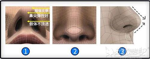 广州荔医鼻综合采用立体连拱方法可让假体不顶透,无惧揉捏