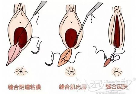 阴道紧缩手术的原理图