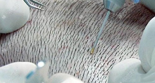 选择西安丝倍梵的倍速植发技术可以种植发际线吗？