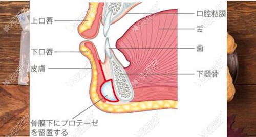 下巴假体放置的位置