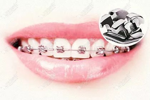 牙齿正畸是选择金属托槽矫正好还是3M透明托槽矫正好