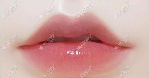 M唇手术一个半月了嘴还硬的凸起是恢复慢还是疤痕增生？